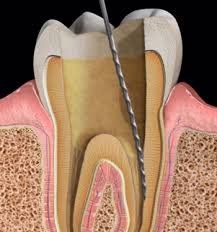 Endodoncias