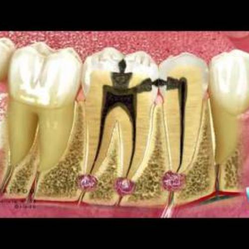 ¿que es la endodoncia?