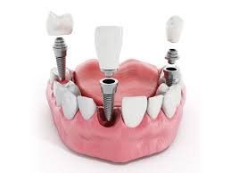 Colocación de implantes dentales